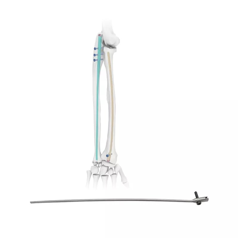Radio Intramedular Nail