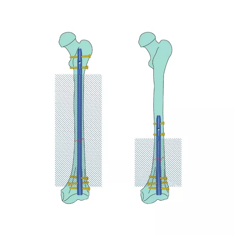 Experto Invertido Intertanes femorales Intramedular Nail