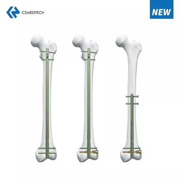 Experto R/Afn.Clavo femoral retrógrado/anterógrado