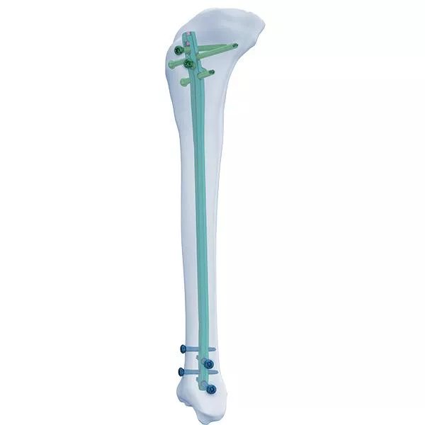 Expert Tibia Clavo