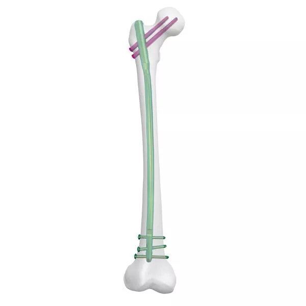 Clavo femoral experto