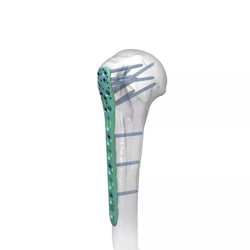 Placa de bloqueo humeral proximal